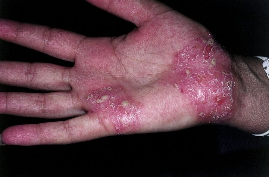 exacerbación de la psoriasis en las manos
