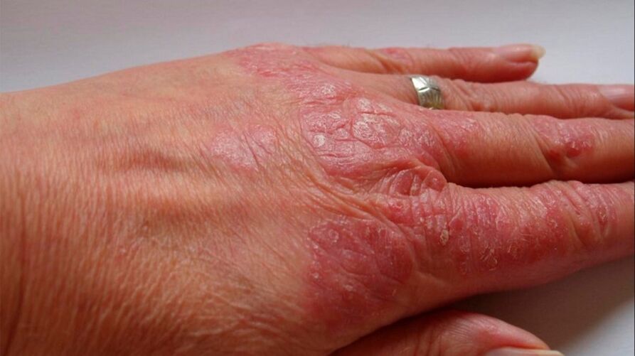 síntomas de psoriasis en las manos