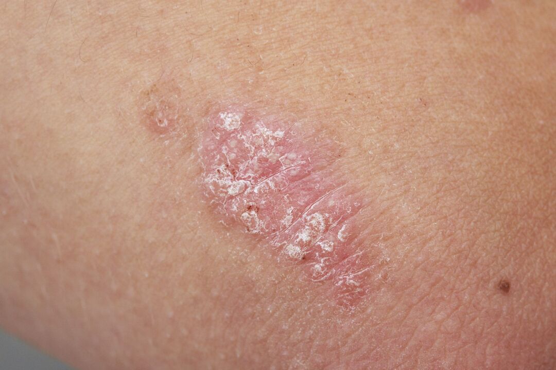 psoriasis en la piel de un niño