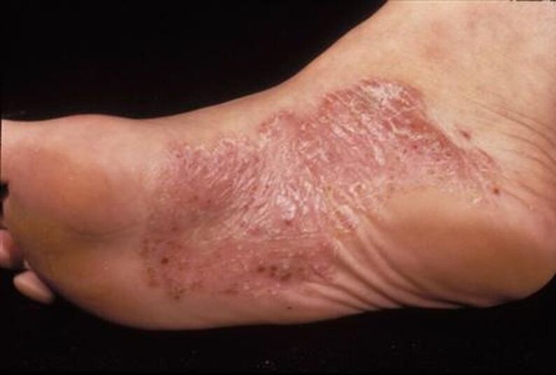 síntomas de la psoriasis en el pie