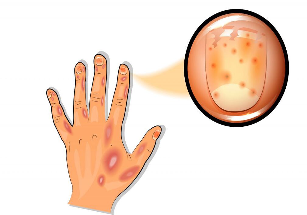 daños en las uñas en la psoriasis