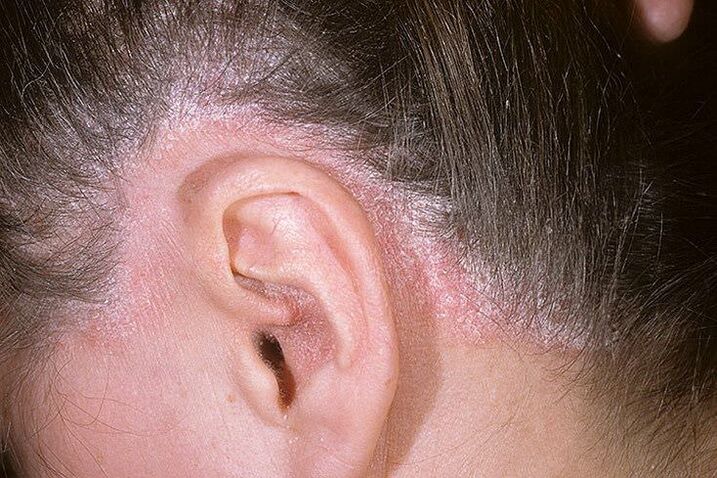 Erupciones de psoriasis en la cabeza detrás de las orejas