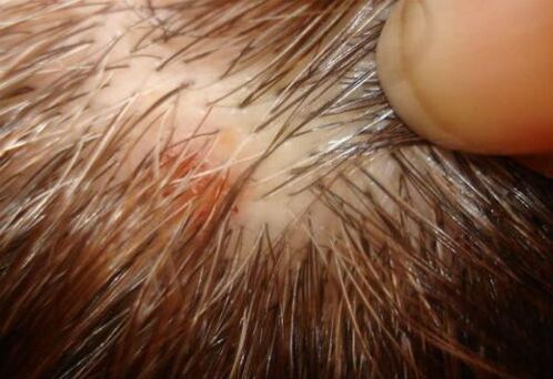 psoriasis en el cuero cabelludo