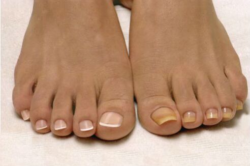 psoriasis en las uñas