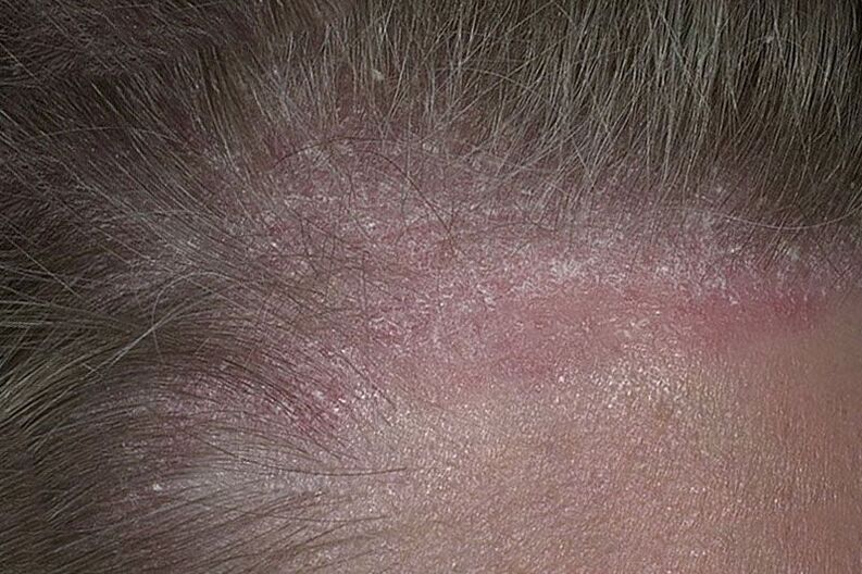 ¿Cómo es la psoriasis del cuero cabelludo 
