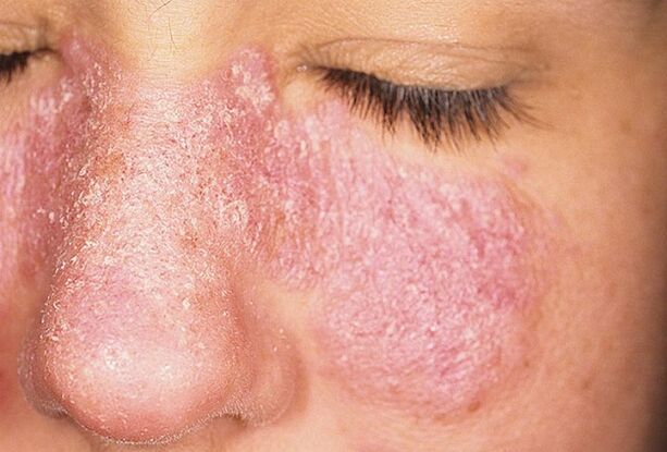 Etapa progresiva de la psoriasis en la piel del rostro. 