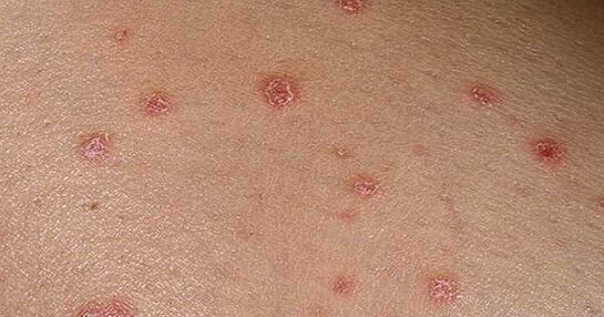 Placas psoriásicas