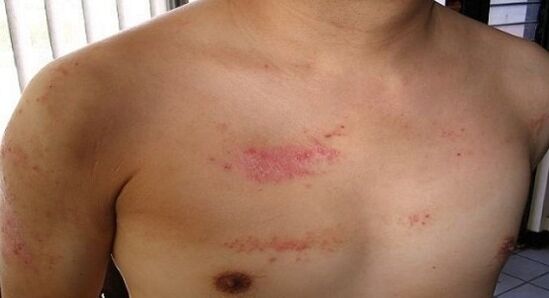 Psoriasis en el área del pecho