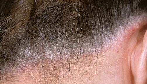 Psoriasis en la cabeza