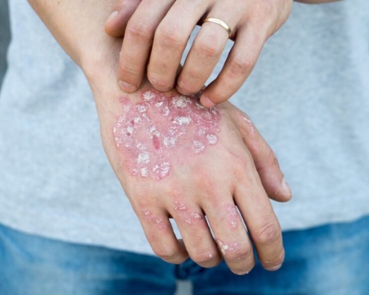 Psoriasis en las manos