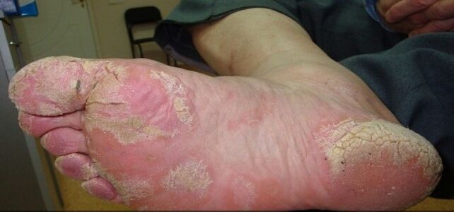 Psoriasis en las piernas