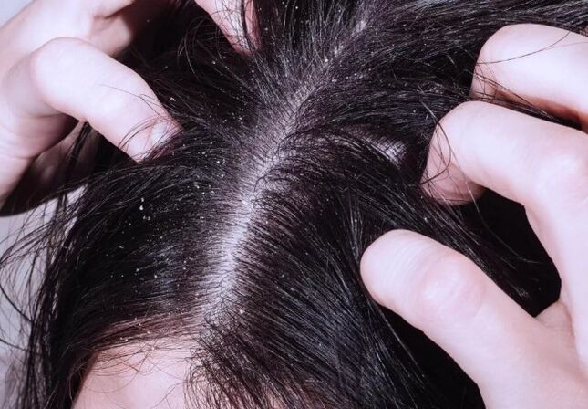 Psoriasis en la cabeza