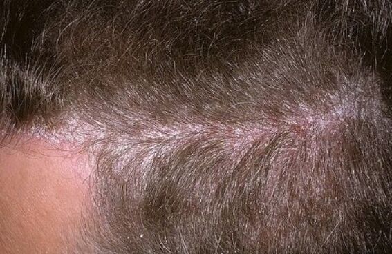 Psoriasis en la cabeza