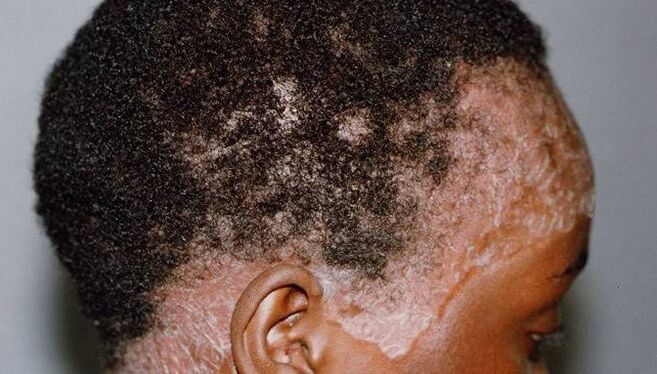 Psoriasis en la cabeza