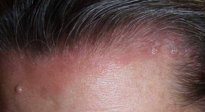 ¿Qué es la psoriasis