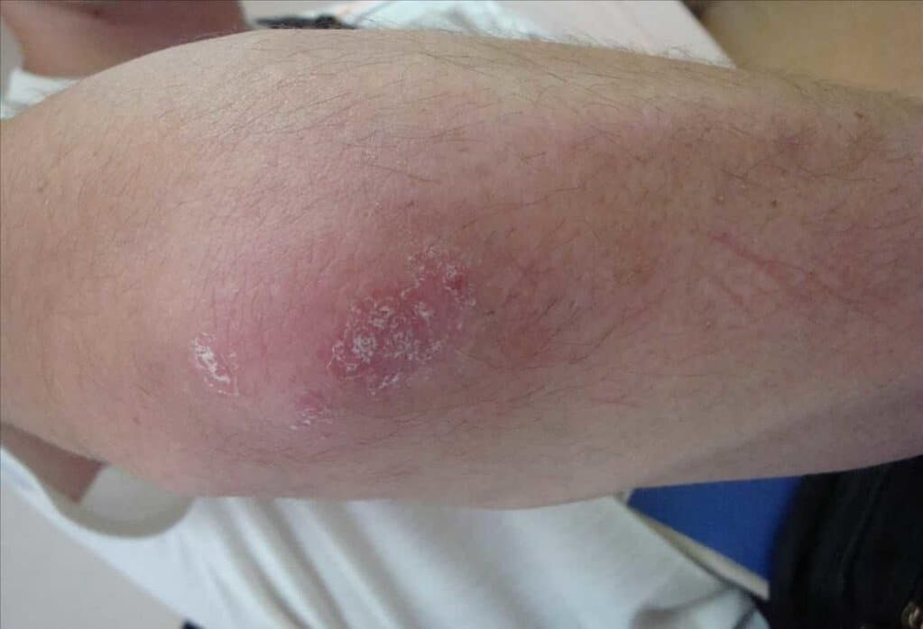 Cómo se ve la psoriasis