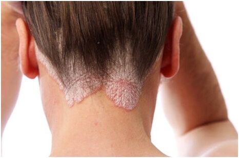 Psoriasis en el cabello
