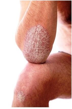 Psoriasis en el codo