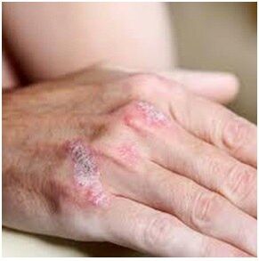 Psoriasis en el pincel