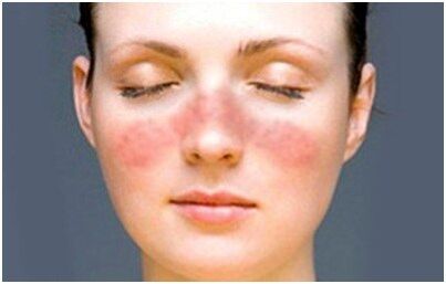 Psoriasis en la cara