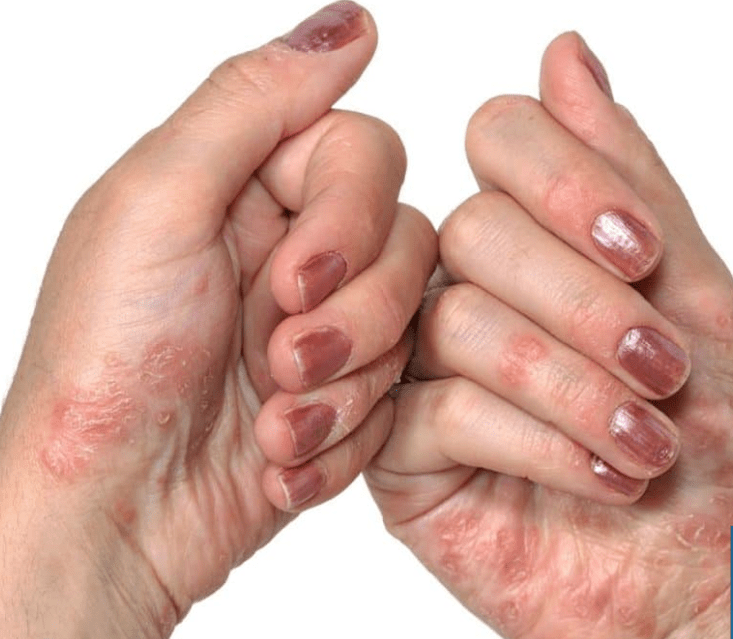 Psoriasis en las manos