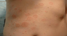 Psoriasis desafortunada