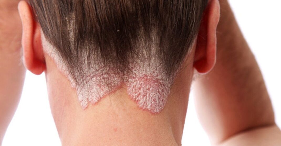 Psoriasis en la cabeza de las chicas