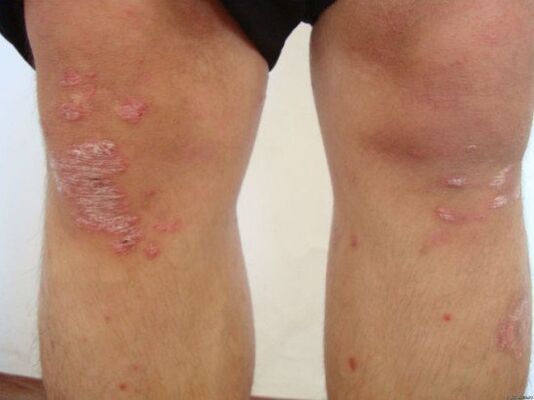 Las causas de la psoriasis