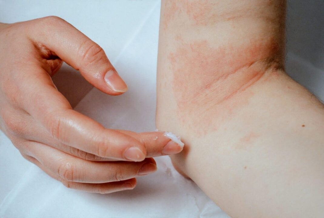 Tratamiento de la psoriasis
