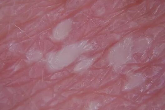 Psoriasis de Pustulenia