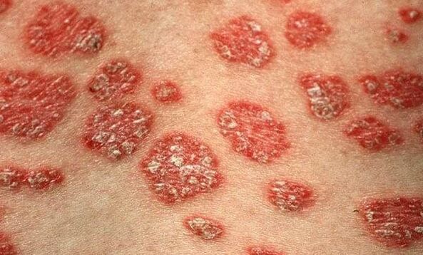 Formas de psoriasis