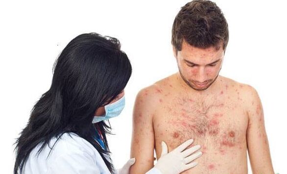 Foto de psoriasis