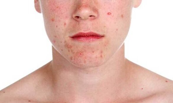 Síntomas de la psoriasis