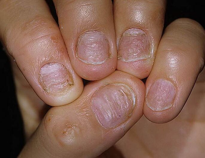 Psoriasis de uñas