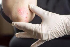 Psoriasis en el codo