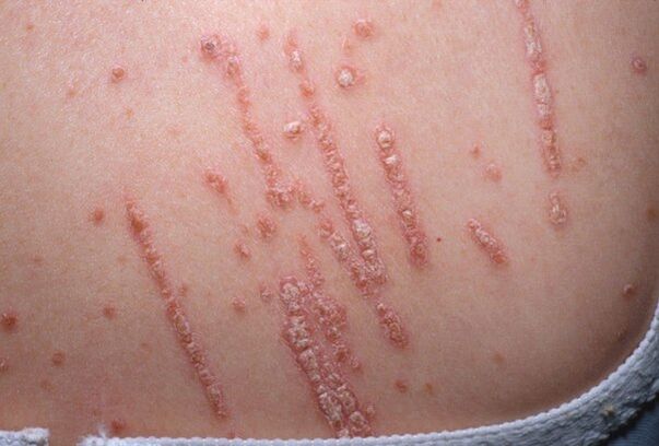 Psoriasis en el cuerpo