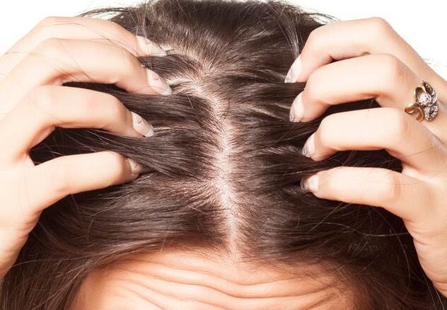 Psoriasis en la cabeza
