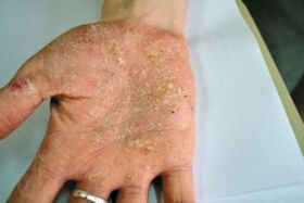 Psoriasis en la palma de tu mano
