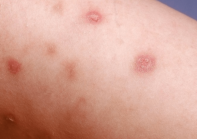 Etapa inicial de la psoriasis.