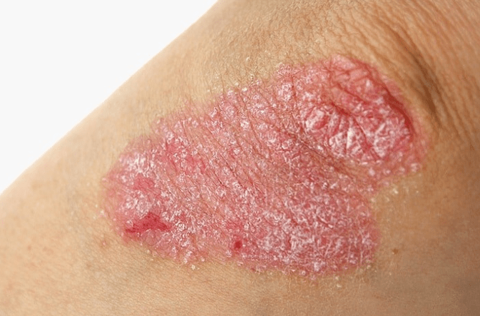 Etapa progresiva de la psoriasis.