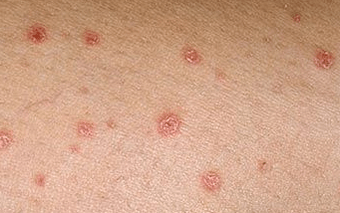 Psoriasis en la etapa inicial.
