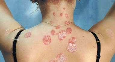 Soriasis