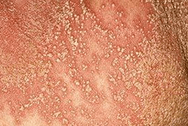 psoriasis pustulosa