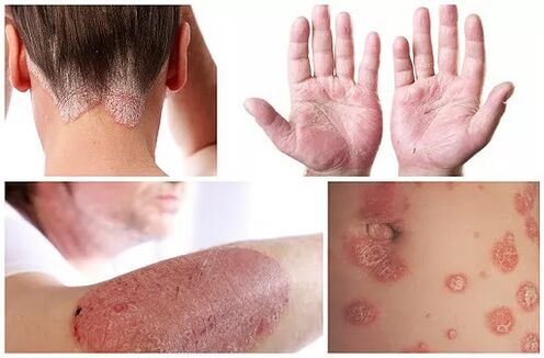 Manifestaciones de psoriasis en diferentes partes del cuerpo.
