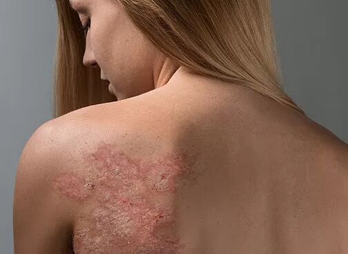 Psoriasis en la espalda de una niña