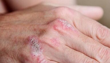 síntomas de la etapa inicial de la psoriasis