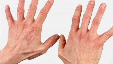 ¿Cómo es la etapa inicial de la psoriasis