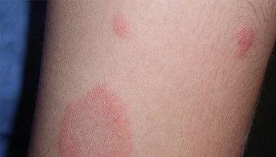 ¿Cómo se manifiesta la etapa inicial de la psoriasis