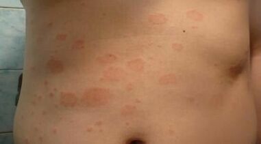 cómo reconocer la etapa inicial de la psoriasis