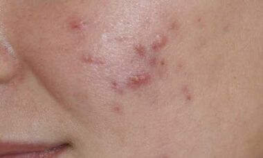 síntomas de la etapa inicial de la psoriasis